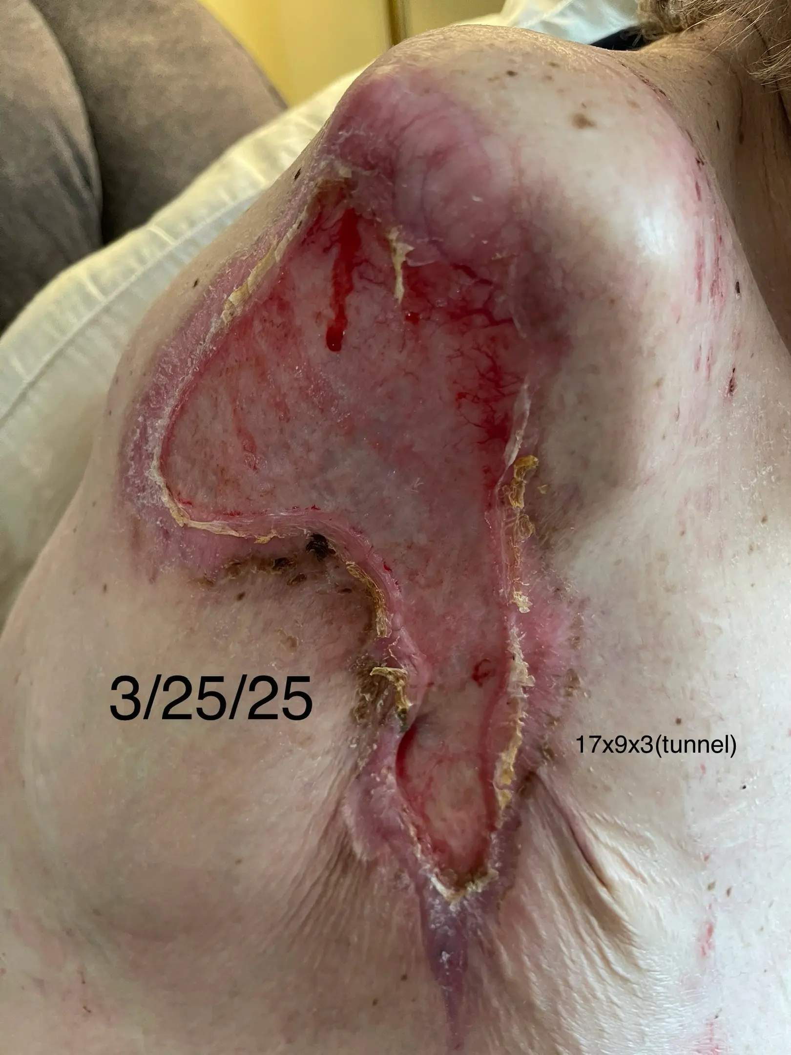 Post-surgical wound following an amputation.